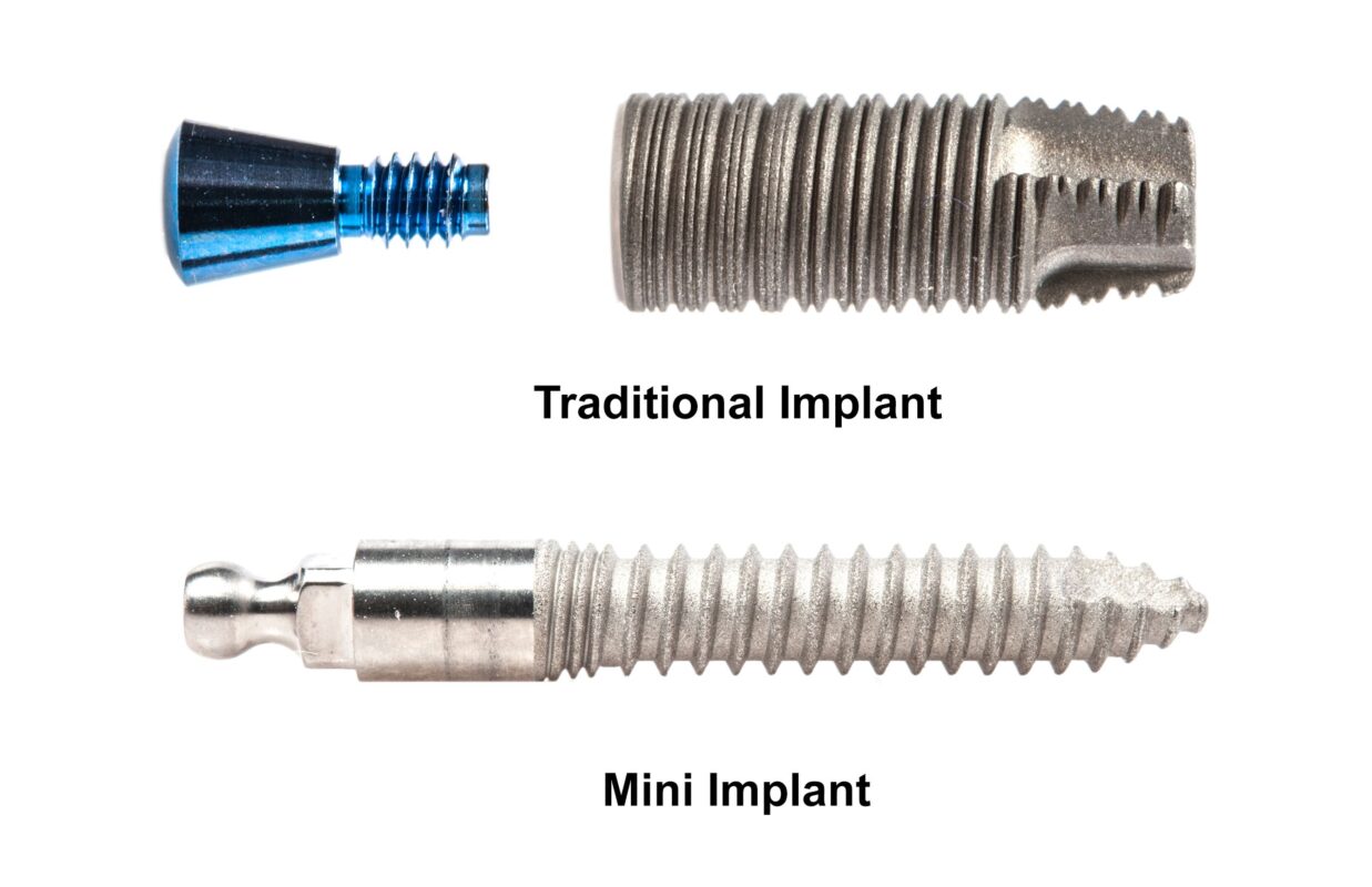 ClearChoice Alternatives in Syracuse, NY | Mini Dental Implants