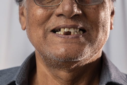 Missing Tooth in Syracuse, NY | Mini Dental Implants | Tooth Loss